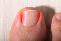 Ingrown Toenails and How They Are Treated