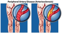 Symptoms and Risks of Peripheral Artery Disease