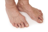 Learning to Manage Rheumatoid Arthritis Affecting the Feet